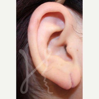 25-34 year old woman treated with Ear Lobe Surgery before 1736899