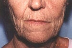 Advanced aging of the mouth. Phenol perioral peel among other treatments. before 1281315