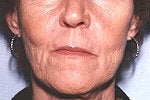 Advanced aging of the mouth. Phenol perioral peel among other treatments. after 1281315