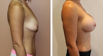 35-44 year old woman treated with Breast Augmentation before 3300095