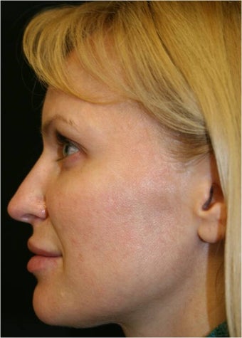 42 Year old female treated for early facial volume loss and aging with Sculptra injections after 718200
