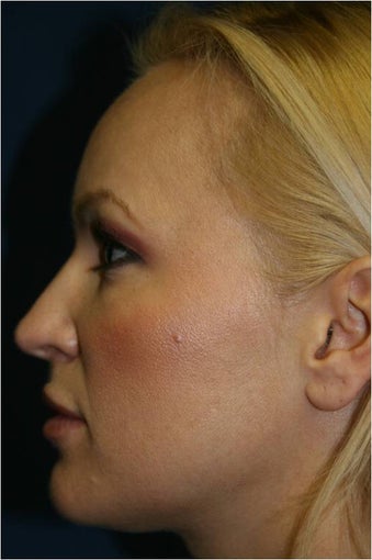 42 Year old female treated for early facial volume loss and aging with Sculptra injections before 718200