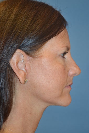 55 year old female who underwent mini-lift after 1045902
