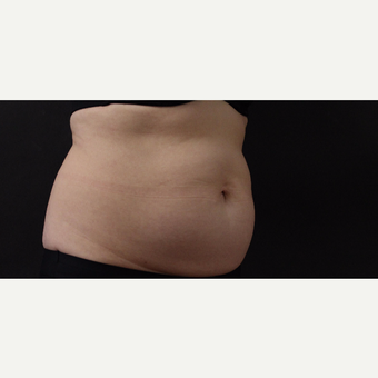 55 year old woman treated with CoolSculpting before 3220740