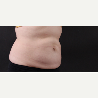 55 year old woman treated with CoolSculpting after 3220740