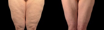18-24 year old woman treated with Liposuction after 2025433