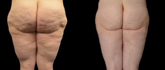 18-24 year old woman treated with Liposuction before 2025433