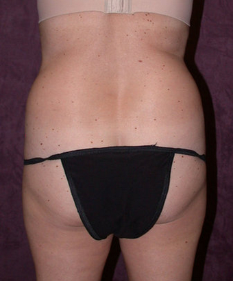 Tummy tuck (abdominoplasty) with liposuction of hips before 94683