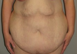 35-44 year old woman treated with Tummy Tuck before 3282360