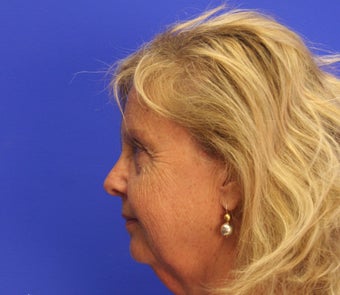 45-54 year old woman treated with Facelift 3476251