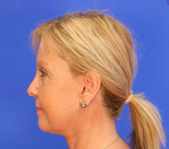 45-54 year old woman treated with Facelift 3476251