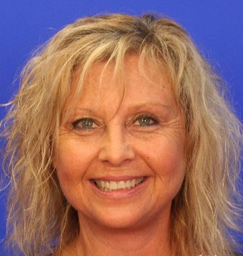 45-54 year old woman treated with Facelift after 3476251