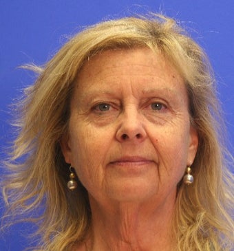 45-54 year old woman treated with Facelift before 3476251