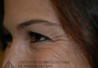 Botox to Periorbital Wrinkles (Crows' Feet) before 315093