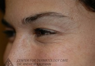 Botox to Periorbital Wrinkles (Crows' Feet) after 315093