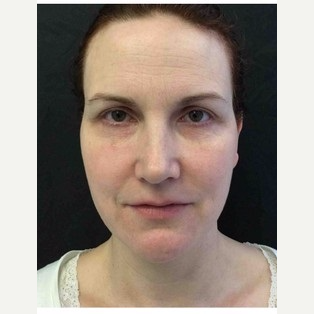 35-44 year old woman treated with Ultherapy before 3179906