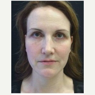 35-44 year old woman treated with Ultherapy after 3179906