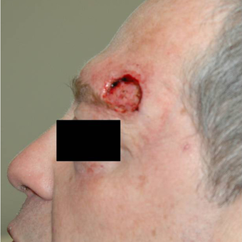Mohs Surgery before 3711118