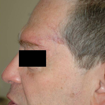 Mohs Surgery after 3711118