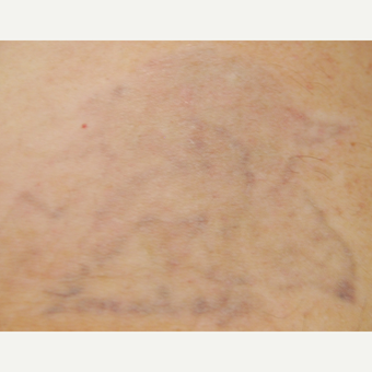 35-44 year old man treated with Tattoo Removal after 3099326