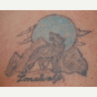 35-44 year old man treated with Tattoo Removal before 3099326