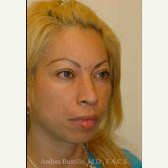 29 year old woman treated with Rhinoplasty before 3460924