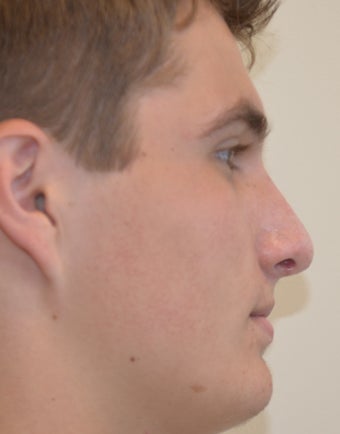 18-24 year old man treated with Rhinoplasty after 2765089