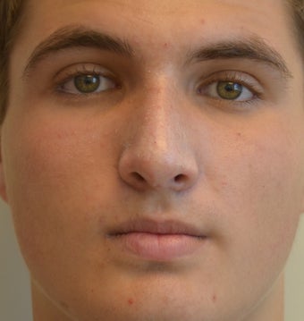 18-24 year old man treated with Rhinoplasty 2765089