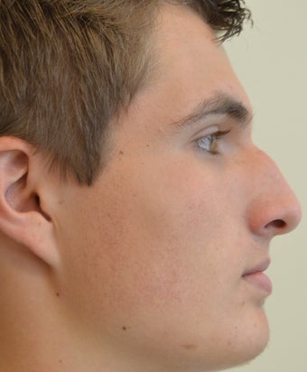 18-24 year old man treated with Rhinoplasty before 2765089