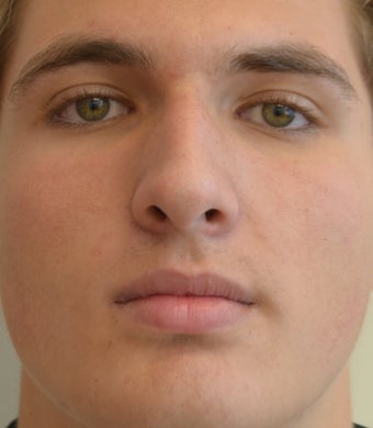18-24 year old man treated with Rhinoplasty 2765089