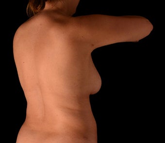 35-44 year old woman treated with Body Jet before 2165205