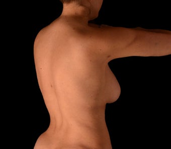 35-44 year old woman treated with Body Jet after 2165205