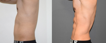 25-34 year old man treated with Vaser Liposuction before 4599317