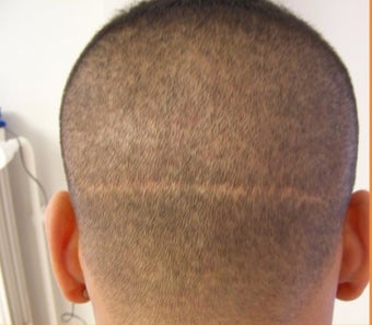 25-34 year old man with FUT (strip) scar treated with FUE Hair Transplant before 3120518