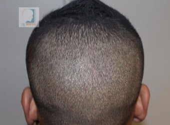25-34 year old man with FUT (strip) scar treated with FUE Hair Transplant after 3120518