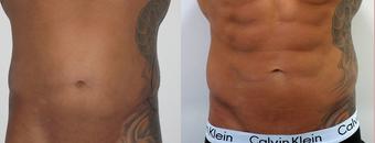 25-34 year old man treated with Vaser Liposuction before 4599312