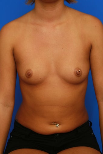 Breast Augmentation before 1007940
