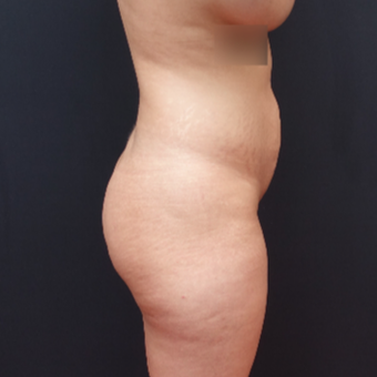 25-34 year old woman treated with Fat Transfer before 3267090