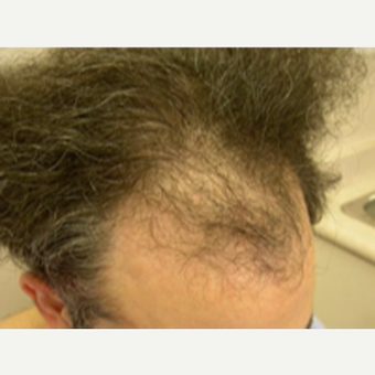 Hair Transplant before 3529261