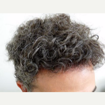 Hair Transplant after 3529261