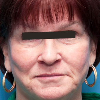 65-74 year old woman treated with Photofacial BBL and anti-redness after 2827002