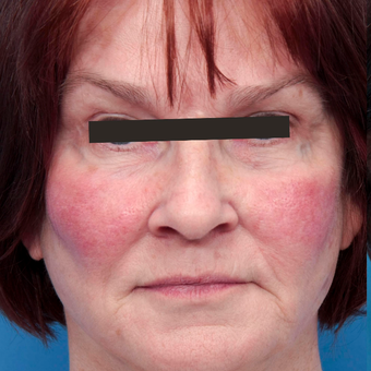 65-74 year old woman treated with Photofacial BBL and anti-redness before 2827002