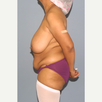 45-54 year old woman treated with Mommy Makeover before 3557865