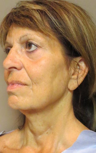 Facelift for this 65 Year Old Woman before 1480039
