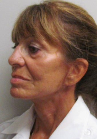 Facelift for this 65 Year Old Woman after 1480039