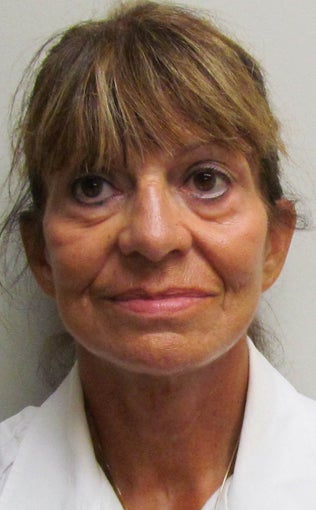 Facelift for this 65 Year Old Woman 1480039
