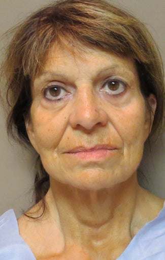 Facelift for this 65 Year Old Woman 1480039
