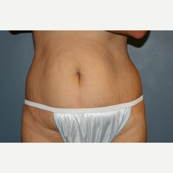 Abdominoplasty with Laser liposuction before 3610129