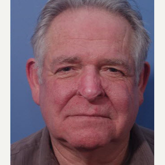 55-64 year old man treated with Laser Surgery after 3710996