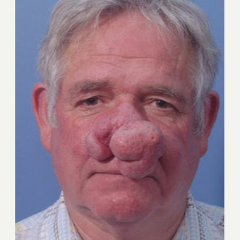 55-64 year old man treated with Laser Surgery before 3710996
